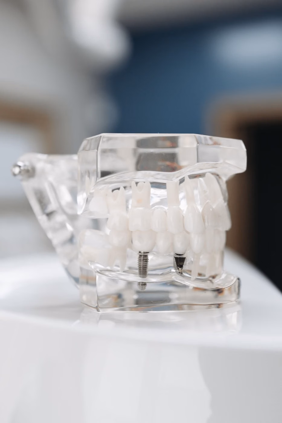 Clear dental model showing implants